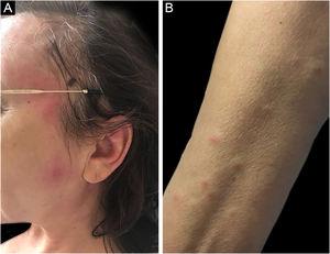 Sweet syndrome in a patient with AML secondary to MDS. Erythematous-edematous papules and plaques affecting (A), face and (B), anterior region of the forearm.
