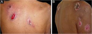 Bullous pyoderma gangrenosum. Shallow ulcers with blue-gray borders (A) on the back and (B) on the upper limb.