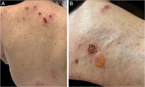Eosinophilic dermatosis in patients with CLL. (A) Erythematous-edematous plaques on the back with ulceration on the upper back resulting from the act of scratching due to intense pruritus. (B) Bullous form with a lesion similar to bullous pemphigoid.