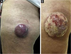 Merkel cell carcinoma located on the left thigh of a male patient. (A) At diagnosis, tumor lesion with cupuliform appearance, with erythema and mild desquamation. (B) Tumor evolution with growth and ulceration throughout the lesion. Source: Courtesy of Dr. Gabriella Campos-do-Carmo (the patient consented to the use of images for educational purposes).