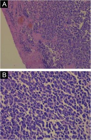 Histopathology of Merkel cell carcinoma with hematoxylin-eosin staining. (A) Cords of tumor cells in the dermis (×200 magnification). (B) Tumor cells showing scarce cytoplasm and round or irregular nuclei (×400 magnification).