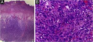 (a) Ulcerated lesion with cell proliferation occupying the superficial and deep dermis. (b) Moderately pleomorphic, fusiform and epithelioid cells, with hyperchromatic nuclei; nucleoli are difficult to distinguish.