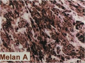 Immunohistochemistry was positive for Melan-A monoclonal antibody, which recognizes a specific melanocytic differentiation protein expressed in benign and malignant melanocytes.