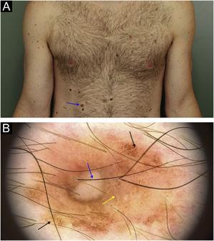 A superficial spreading melanoma, with 0.5mm Breslow’s thickness on the right hypochondrium region: (a) Clinical appearance and location of the lesion (arrow). (b) Dermoscopy showing areas of atypical pigmented network (black arrow), area with reticulated hypopigmentation (yellow arrow); and depigmented/amorphous central area with intermingled linear and irregular vessels (blue arrow).