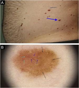 In situ melanoma on the left flank: (a) Clinical aspect of the melanoma, showing characteristics similar to other adjacent lesions (blue arrow). (b) On dermoscopy, an irregular pigmented network can be observed (black arrows), associated with reticulated hypopigmentation or inverted network (blue arrow); and peripheral punctiform blood vessels (green arrow).