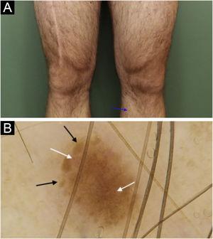 In situ melanoma on the anteromedial region of the left lower limb: (a) Clinical aspect of lesion measuring 1.5mm (blue arrow), with light brown color, similar to other pigmented lesions on both lower limbs. (b) Dermoscopy of the lesion, showing a somewhat symmetrical lesion, light brown in color, containing peripheral globules with irregular distribution and sizes (black arrow); linear, comma shaped and intermingled globular shaped vessels (white arrow).