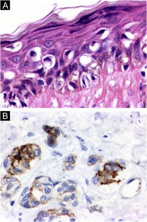 Histopathology: (a) In situ melanoma on the left leg showing intense cytological atypia and exuberant pagetoid dissemination (Hematoxylin & eosin, ×100). (b) HMB45 immunohistochemical positivity in neoplastic cells in both the epidermal and dermal components of the invasive melanoma on the abdominal region (×100).