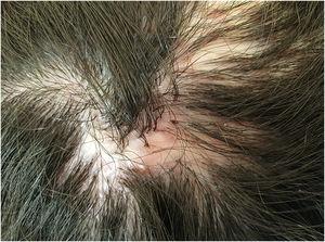 Cicatricial alopecia, with follicular pustules at the periphery, erythema and perifollicular desquamation, in addition to areas with polytrichia.