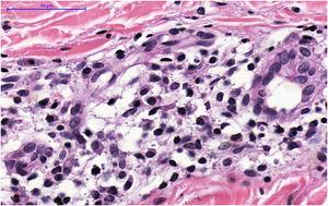 Presence of numerous plasma cells and histiocytes amidst the mixed perifollicular infiltrate (Hematoxylin & eosin, ×400).