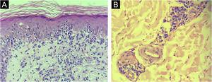 Skin, histopathological findings. (A) Interface dermatitis (Hematoxylin & eosin, ×400). (B) Endothelial hyperplasia and abundant plasma cells around dermal vessels (Hematoxylin & eosin, ×400).