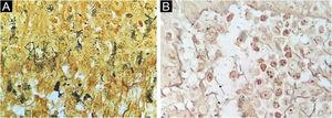 (A) Basal cell layer background staining (Warthin-Starry staining, ×1000). (B) Unspecified structures in dermis (arrows, Warthin-Starry staining, ×1000).