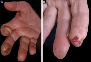 Clinical aspect. (A) Right hand - subungual ulceration on the index finger, ulcer with a callus border on the distal phalanx of the middle finger, and atrophy of the thenar region. (B) Left hand - ulceration on the distal phalanx of the index finger and decrease in the size of the phalanx; there is also a healed area on the distal phalanx of the middle finger.