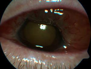 Caso 1. Gran quemosis con fibrina en área pupilar y vitritis que impide enfocar el fondo de ojo.