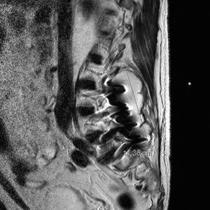 Caso 2. Resonancia magnética de columna lumbar (sagital T2) con absceso paraespinal de 11,3×10cm alrededor de la artrodesis.