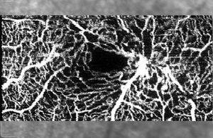 Imagen de OCT-A en la que se observa dilatación vascular con anastomosis vasculares anómalas y aumento de los espacios intervasculares en la zona parafoveal temporal.