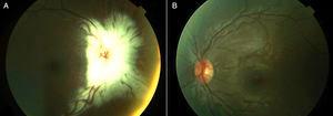 A) Mielinización de fibras nerviosas de la retina, abundantes a nivel del nervio óptico. Nótese el aspecto hipoplásico del nervio óptico. B) Fundoscopía indirecta del ojo izquierdo normal.