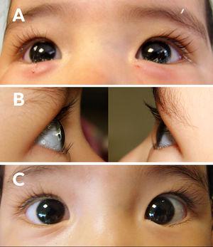 Paciente femenino de un año de edad con epiblefaron bilateral. A) Foto clínica postratamiento inmediato con 5 UI de TbA en región pretarsal del músculo orbicular. B) Fotos clínicas al mes de tratamiento con 5 UI de TbA. Se muestran ojo derecho y ojo izquierdo respectivamente sin toque cilio corneal. C) Foto clínica frontal de ambos ojos al mes de tratamiento con 5 UI de TbA.