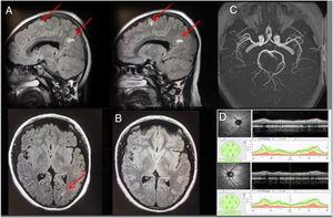 Se muestran las pruebas complementarias de la paciente 2 (AOJ) A) Imagénes sagitales y axial de MRI y secuencia FLAIR con gadolinio donde se observan las lesiones hiperintensas en sustancia blanca yuxtacortical sugerentes de enfermedad desmielinizante. B) Imagen de MRI con gadolinio en T2 donde se observa la disminución y/o desaparición de algunas de las lesiones hiperintensas, a los 3 meses. C) Imágenes de angio-MRI sin alteraciones. D) OCT-SD de la capa de fibras nerviosas de la retina sin alteraciones.