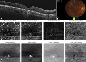 Imagen multimodal de hallazgos posoperatorios OD. A. OCT B-scan que muestra cierre del agujero macular con regeneración incompleta de las capas externas de la retina. B. Fotografía a color muestra migración del EPR temporal a la fóvea y agujero macular cerrado. C. OCT-Angiografía revela resolución de la lesión hiperreflectiva vista en el preoperatorio y solo se ven las telangiectasias en el plexo vascular superficial y profundo. D. Imagen En-face muestra lesiones hiperreflectivas las cuales corresponden a telangiectasias maculares, sin embargo, sin la lesión hiperreflectiva vista en el preoperatorio.