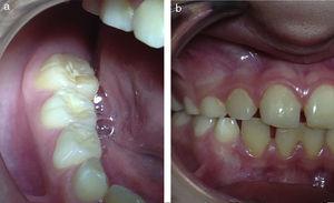 Paciente de 9 años, con dentición mixta primera fase final, donde ya se observa desgastes dentarios aumentados en el primer molar permanente (1a) y la pérdida de las cúspides de los caninos en desgastes coincidentes (1b).