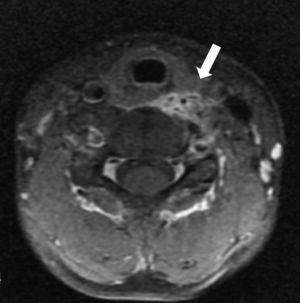 Resonancia magnética secuencia T1 con gadolinio; muestra realce patológico del proceso inflamatorio de las partes blandas paravertebrales a izquierda.