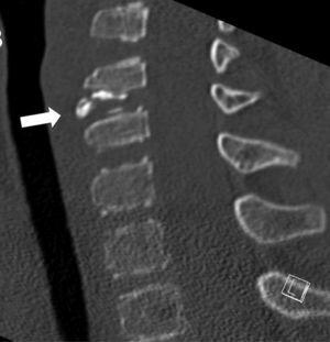 Tomografía computarizada, reconstrucción sagital con ventana ósea. Detalle de calcificación fragmentada discal C5-C6 (flecha).