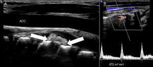 A. Ultra sonografía de carótida común izquierda normal, en profundidad se visualiza calcificación extruida antero-lateral izquierda (flechas). B. Ultra sonografía doppler de arteria vertebral izquierda que muestra flujo conservado.