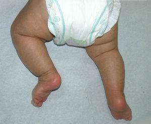 Ictiosis vulgar en niño de 11 meses. Se observa compromiso de extremidades inferiores que respeta los pliegues.