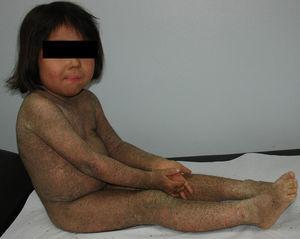 Ictiosis epidermolítica en niña de 5 años.