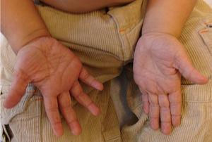Hiperlinearidad palmar en un niño con ictiosis vulgar.