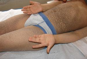 Ictiosis recesiva ligada a X. Compromiso en el abdomen y en las extremidades; respeta las palmas.