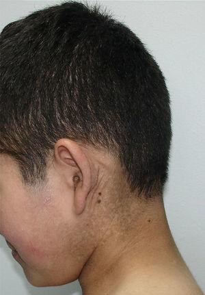 Ictiosis recesiva ligada a X. Se observa compromiso en la región cervical («cuello sucio»).