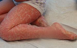 Niña de 4 años con ictiosis arlequín en tratamiento con acitretin.