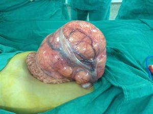 Lipoblastoma exteriorizado durante el acto quirúrgico.