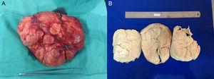 A. Pieza quirúrgica extraída. B. Estructura macroscópica interna del tumor.
