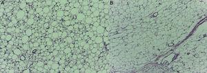 A. Corte histológico con características típicas de lipoblastoma en donde se aprecian adipocitos en distintos grados de diferenciación. B. Tabiques finos y estructura capilar vascular. (Hematoxilina-eosina; 40×).
