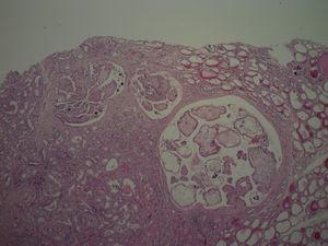 Visión con bajo aumento del carcinoma papilar: se observa arquitectura papilar y folículos neoplásicos. Aumento 2,5×; tinción hematoxilina-eosina.