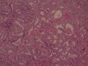 Patrón folicular de carcinoma papilar; destacan núcleos con cromatina finamente dispersa y membrana nuclear prominente debido a la marginación de la cromatina. Aumento 5×; tinción hematoxilina-eosina.