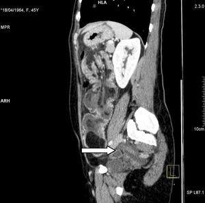 Corte longitudinal de TC abdomino-pélvica, en la que se muestra la imagen característica en “salchicha” de la invaginación intestinal.