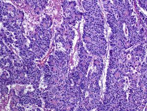 Carcinoma neuroendocrino de bajo grado de colon con extensa formación de rosetas.