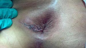 Lesión anterolateral izquierda a menos de 5 cm del margen anal que muestra cambios posteriores a la biopsia incisional.