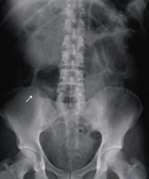 Radiografía AP de abdomen de paciente masculino de 66 años que muestra alfileres en la luz apendicular.