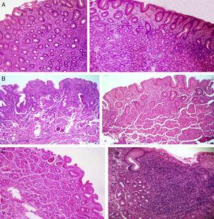 A) Gastritis predominantemente antral (40×/40×). B) Pangastritis (40×/40×). C) Gastritis predominantemente corporal (40×/100×). Mucosa de antro: microfotografías del lado izquierdo. Mucosa de cuerpo: microfotografías del lado derecho. Tinción: hematoxilina eosina.