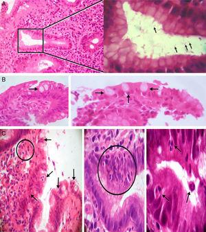A) Izquierda: gastritis crónica antral con presencia de Helicobacter pylori en una luz glandular señalada con un cuadro (izquierda). Tinción: hematoxilina eosina (100×). Derecha: mayor aumento del área del cuadro en la que se observan algunos bacilos Helicobacter pylori (flechas) (inmersión). B) Metaplasia intestinal. Presencia de células caliciformes (flechas) (40×/100×; izquierda y derecha, respectivamente). C) Presencia de células inflamatorias polimorfonucleares tipo neutrófilos que infiltran la lámina propia, el epitelio de revestimiento y la luz glandular (flechas y círculos) (40×/400×/inmersión; de izquierda a derecha, respectivamente).