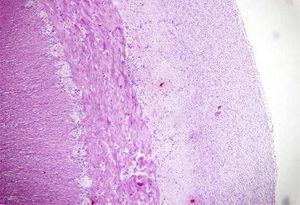 Histopatología, tinción de hematoxilina y eosina: serosa del intestino con banda fibrosa que oblitera la luz.