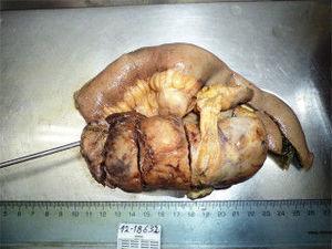 Pieza quirúrgica del tumor fibroso solitario confinado en mesenterio de íleon.