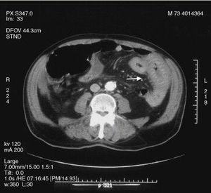 Tomografía computarizada mostrando edema y hemorragia intramural en el duodenodistal y el yeyuno proximal (flecha).