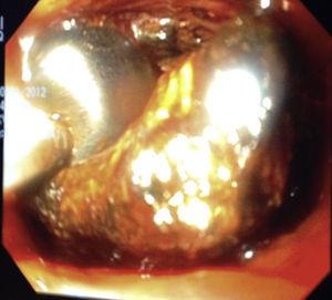 Visión de una coldedocoscopia transquirúrgica con extracción activa de un gran cálculo ubicado en la confluencia y el conducto hepático izquierdo, mediante un balón endoscópico.