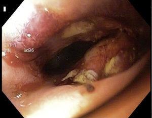Coledocoscopia transoral posquirúrgica inmediata. Se observa coledocoduodeno-anastomosis recién formada, con vía biliar al fondo.