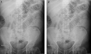 Imágenes de la radiología simple. Se objetivan datos de obstrucción de intestino delgado.